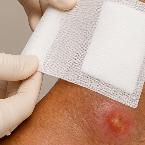 Una investigación enfermera de La Fe valida una técnica que identifica bacterias en heridas crónicas de forma precoz